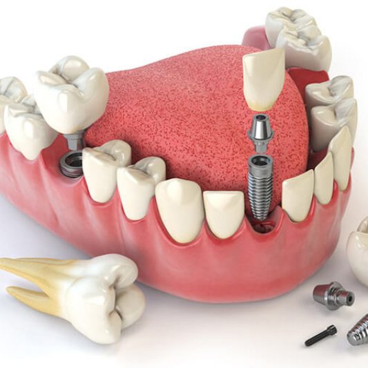 dental_implants_bg_herov2-1 dental_implants_bg_herov2-1